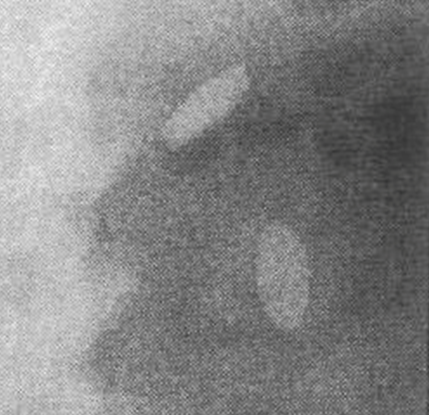 The x ray below shows tablets sitting undigested in the body