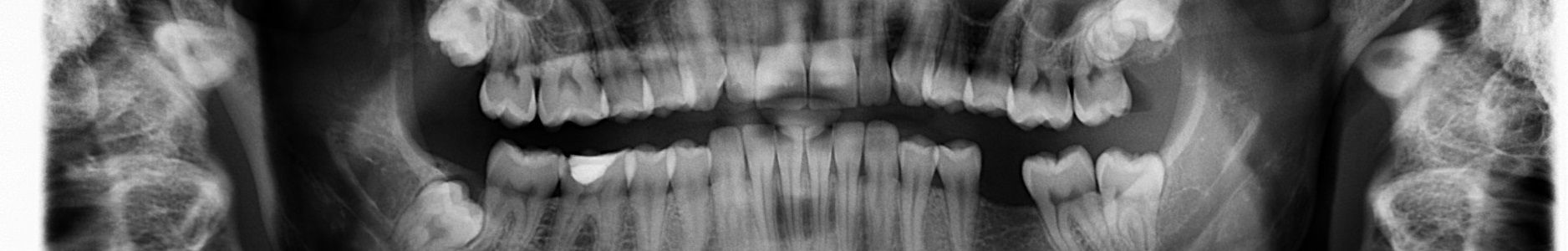 teeth bones xray